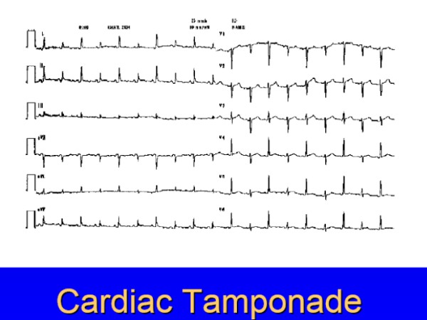 cardiac tamponade