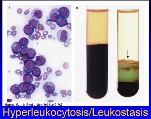 hyperleukocytosis