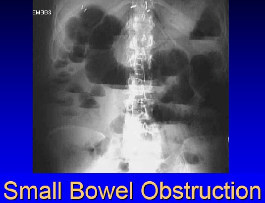 small bowel obstruction