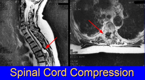 spinal cord compression