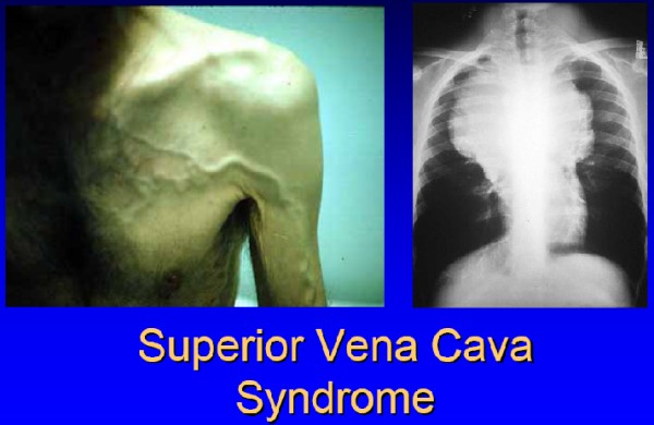 superior vena cava syndrome