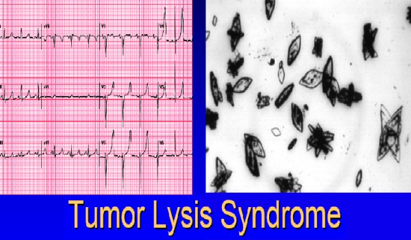 tumor lysis syndrome